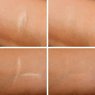 Permanent Make-Up Narbenbehandlung
